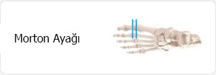 Morton Ayağı
