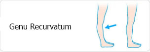 Genu Recurvatum