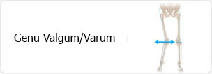 Tibial Varum