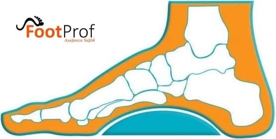 Çukur Taban Tedavisi - ORTHOGEZ