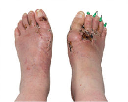 Diyabetik Ayak Tabanlığı - ORTHOGEZ