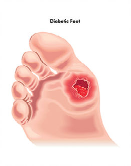 Diyabetik Tabanlık