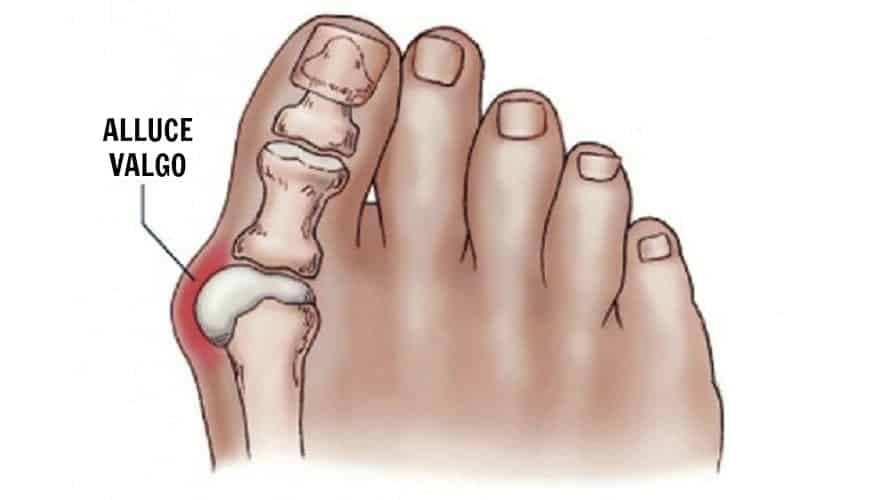 Hallux Valgus Tedavisi - ORTHOGEZ