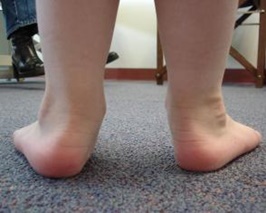 İçe Basma Tedavisi - ORTHOGEZ